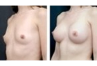 Breast Fat Transfer Case Study